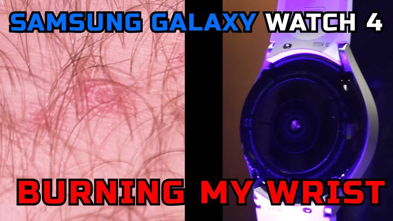 Symptoms of a Burn or Skin Reaction from a Wearable Device