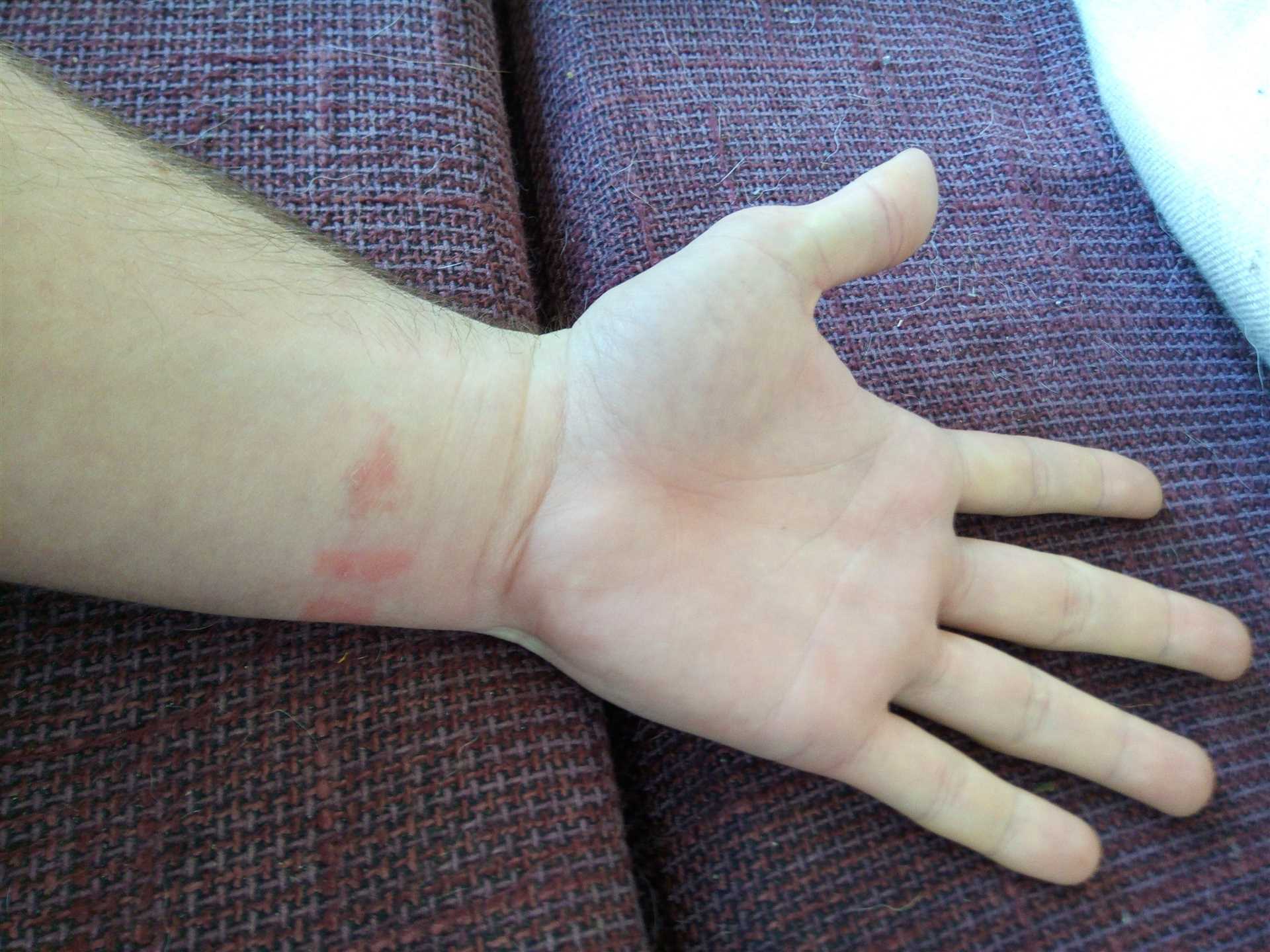 Common Causes of Skin Irritation from Smart Devices