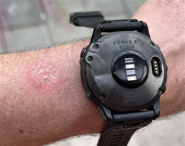 Can garmin watch burning wrist - Wrist Chronicles