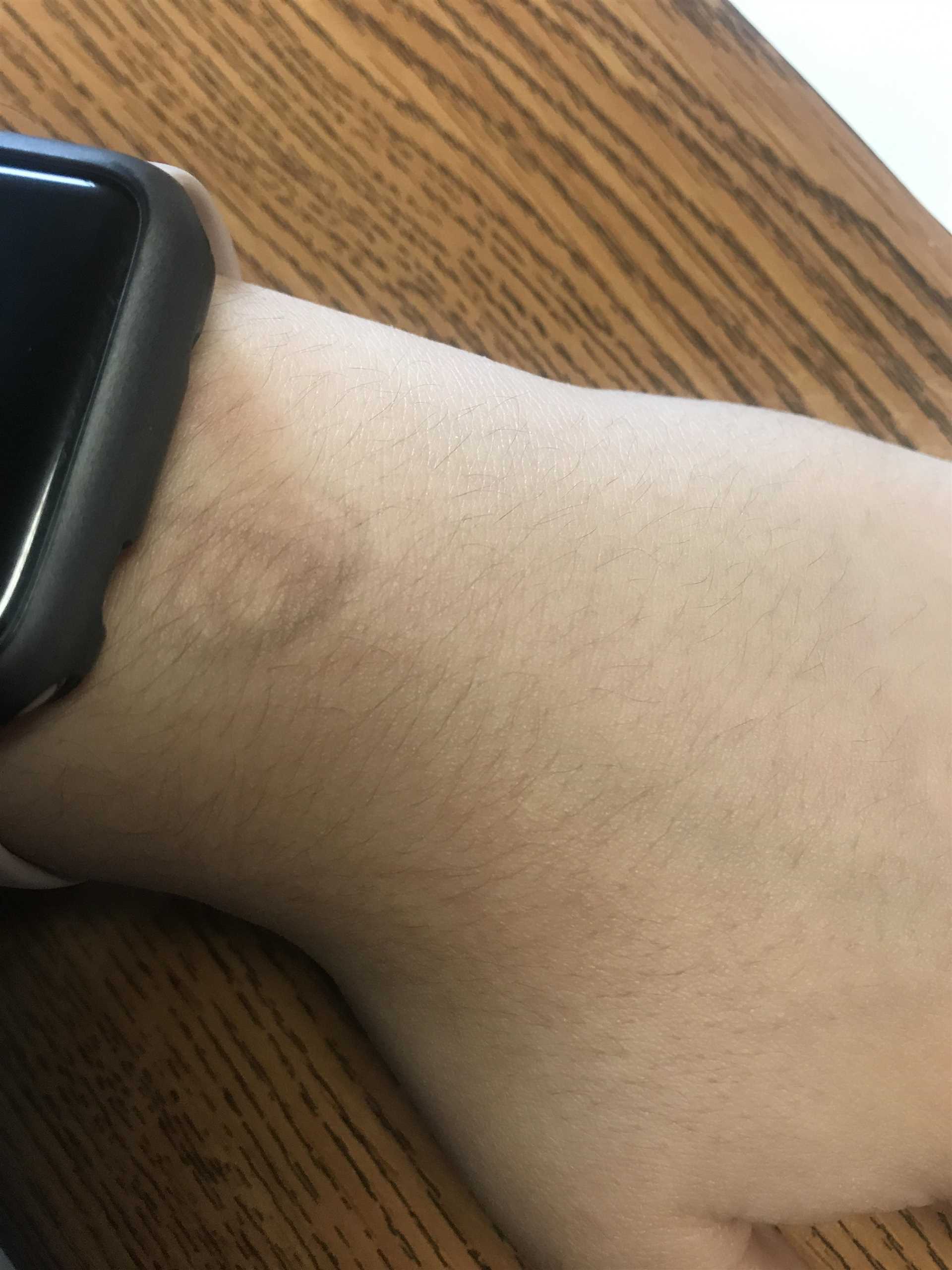 Frequency and Duration of Watch Use: A Risk Factor?
